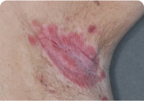 Image of armpit at day 0