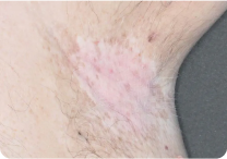 Image of armpit at week 8