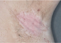 Image of armpit at week 4