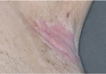 Image of armpit at week 2