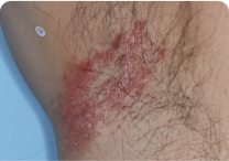 Image of armpit at day 0