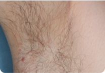 Image of armpit at week 8
