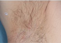 Image of armpit at week 4