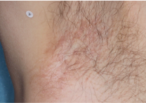 Image of armpit at week 2