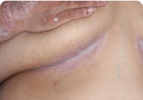 Image of under breast at day 0
