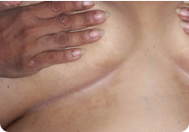 Image of under breast at week 8