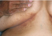 Image of under breast at week 4