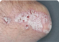 Image of elbow at day 0