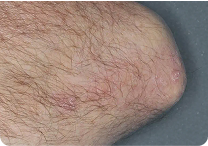 Image of elbow at week 8