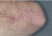 Image of elbow at week 4