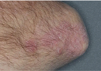 Image of elbow at week 2