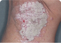 Image of knee at day 0