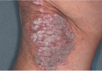 Image of knee at week 2