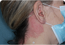 Image of neck at day 0