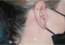 Image of neck at week 4