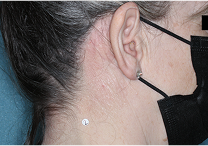 Image of neck at week 2