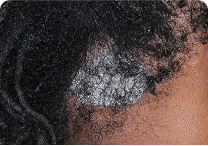 Image of scalp at day 0