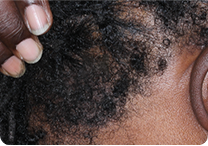 Image of scalp at week 8