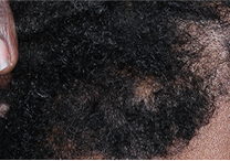Image of scalp at week 4