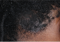 Image of scalp at week 2
