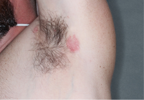 Armpit clinical trial photo – before treatment