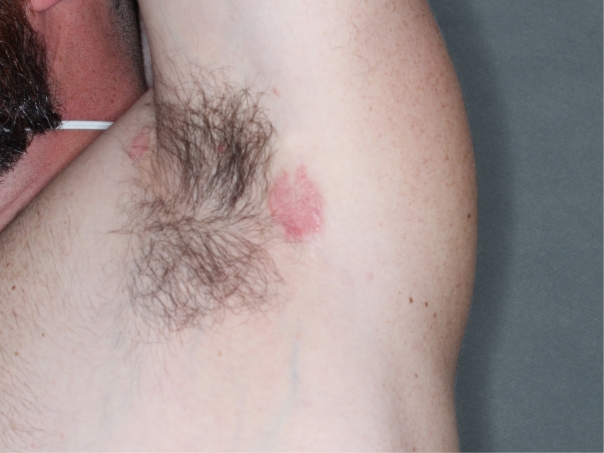 Armpit clinical trial photo – before treatment
