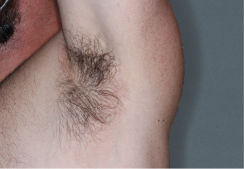 Armpit clinical trial photo – week 4