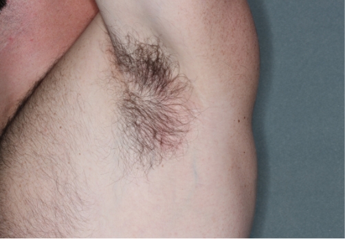 Armpit clinical trial photo – week 8