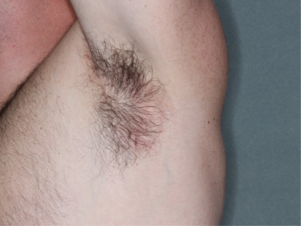 Armpit clinical trial photo – week 8