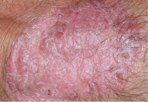 Elbow clinical trial photo – before treatment