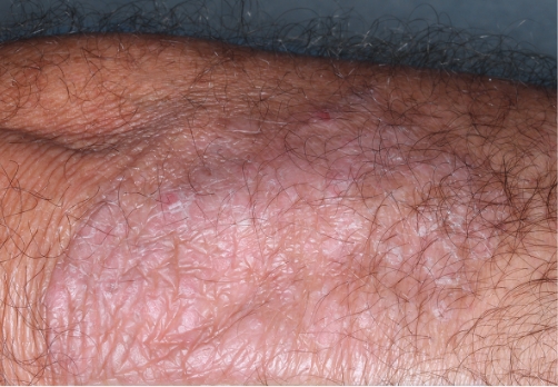 Elbow clinical trial photo – week 4