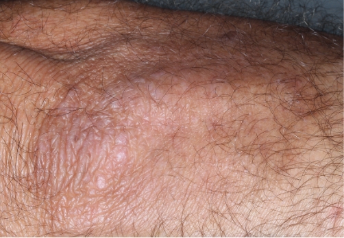 Elbow clinical trial photo – week 8