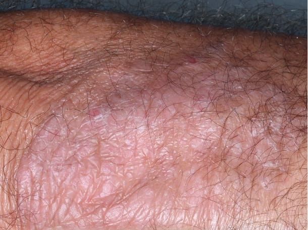 Elbow clinical trial photo – week 4