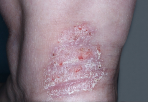 Heel clinical trial photo – before treatment