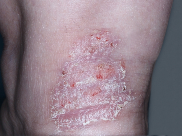 Heel clinical trial photo – before treatment
