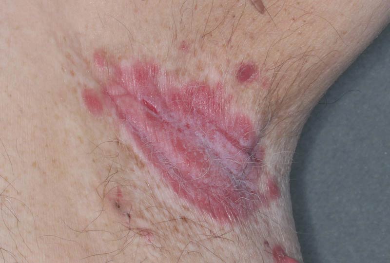 Armpit clinical trial photo – before treatment