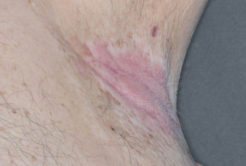 Armpit clinical trial photo – week 2