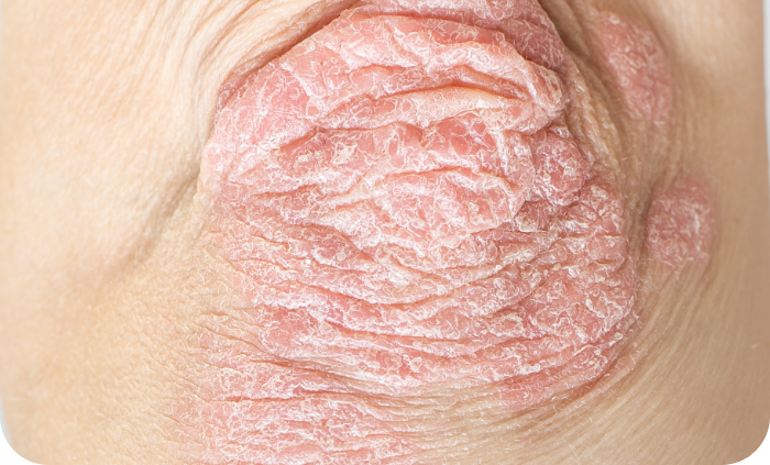 Plaque psoriasis on an elbow