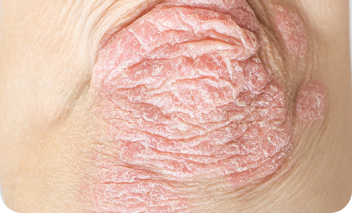 Plaque psoriasis on an elbow Plaque psoriasis on an elbow