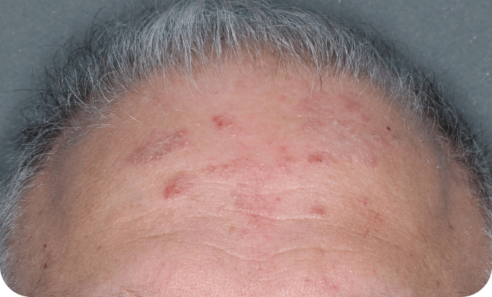 Plaque psoriasis on an elbow Plaque psoriasis on an elbow