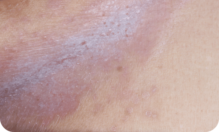 Plaque psoriasis on an intertriginous area Plaque psoriasis on an intertriginous area