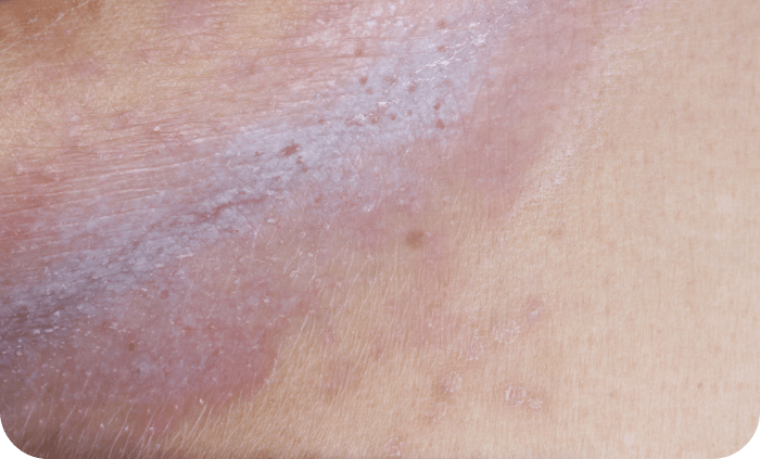 Plaque psoriasis on an intertriginous area