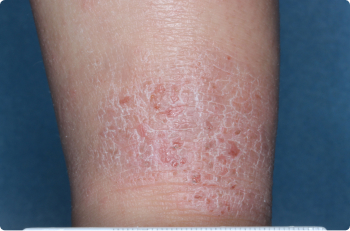 Ankle of clinical trial patient before starting treatment with ZORYVE