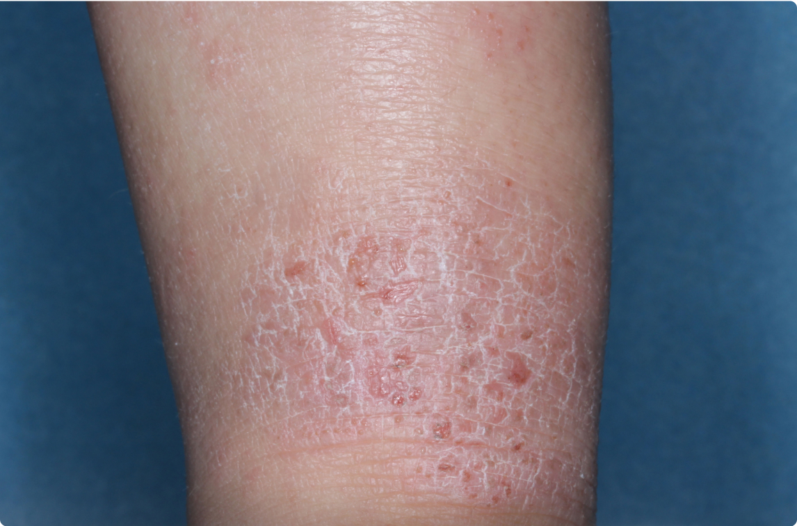 Ankle of clinical trial patient before starting treatment with ZORYVE