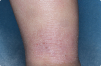 Ankle of clinical trial patient 1 week after ZORYVE treatment