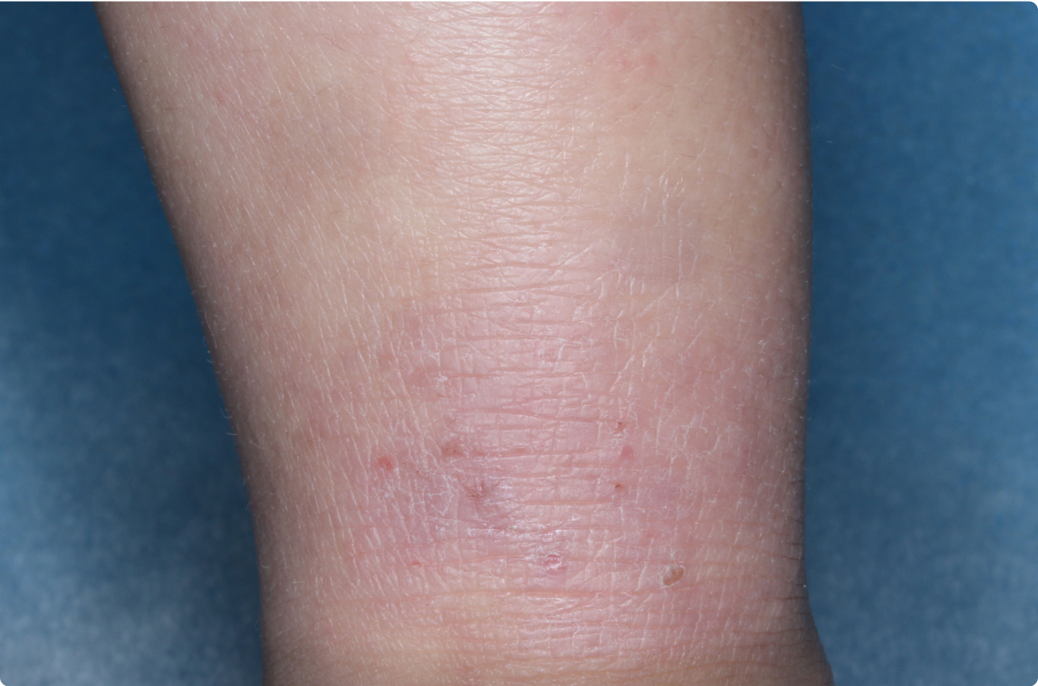 Ankle of clinical trial patient 1 week after ZORYVE treatment