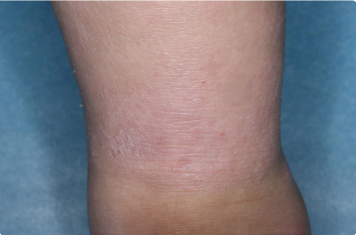 Ankle of clinical trial patient 4 weeks after ZORYVE treatment