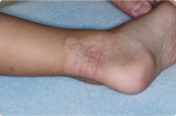 Ankle of clinical trial patient before starting treatment with ZORYVE