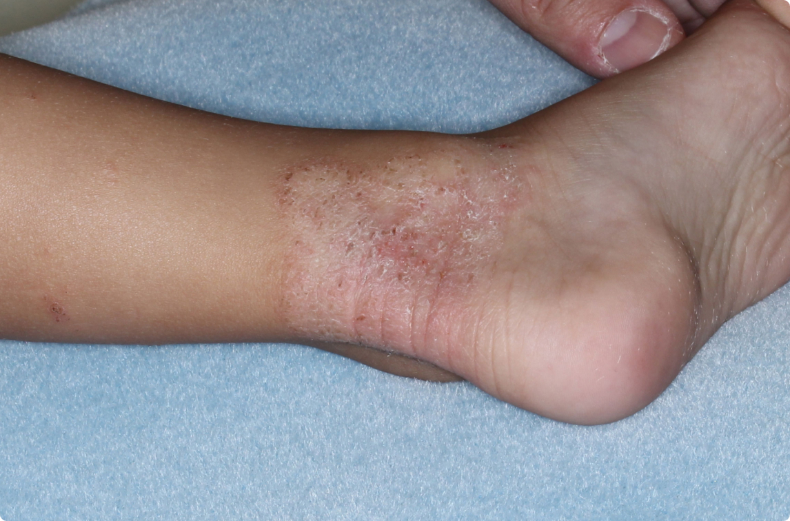 Ankle of clinical trial patient before starting treatment with ZORYVE