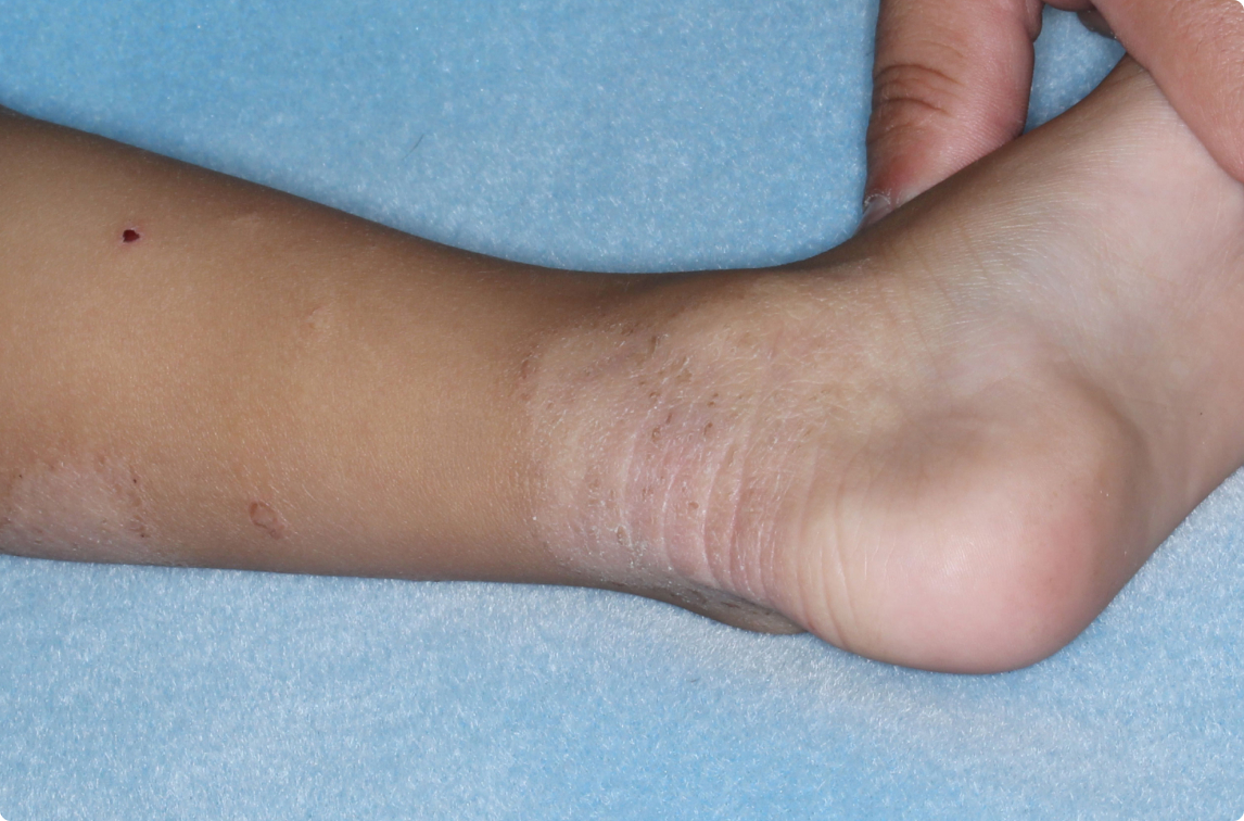 Ankle of clinical trial patient 1 week after ZORYVE treatment